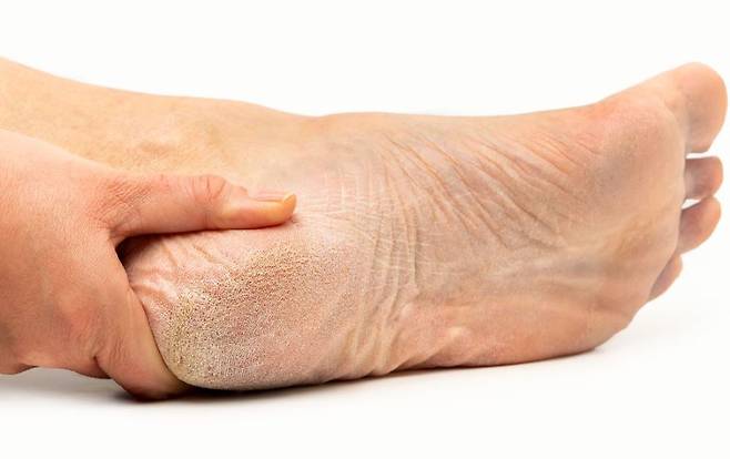 발 각질이나 굳은살을 제거할 때는 마른 상태에서 제거하고, AHA 성분이 있는 과일 껍질이나, 각질연화제를 사용하는 게 좋다./사진=게티이미지뱅크