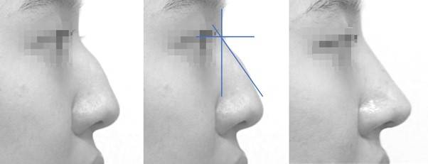 콧대가 높은 매부리코의 원인도 대개 낮은 코끝입니다. 콧등을 줄이면서, 코끝을 높여 줍니다.