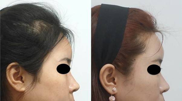 지방이식으로 어색하게 튀어나온 이마 때문에 오히려 코가 작아 보입니다.