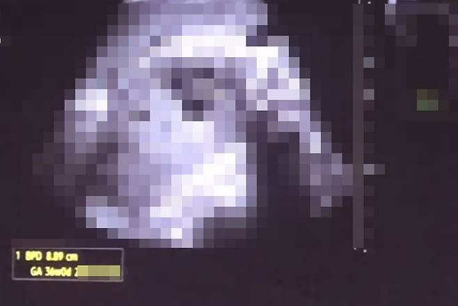 태아 초음파 사진./유튜브 채널 '꼼죽'