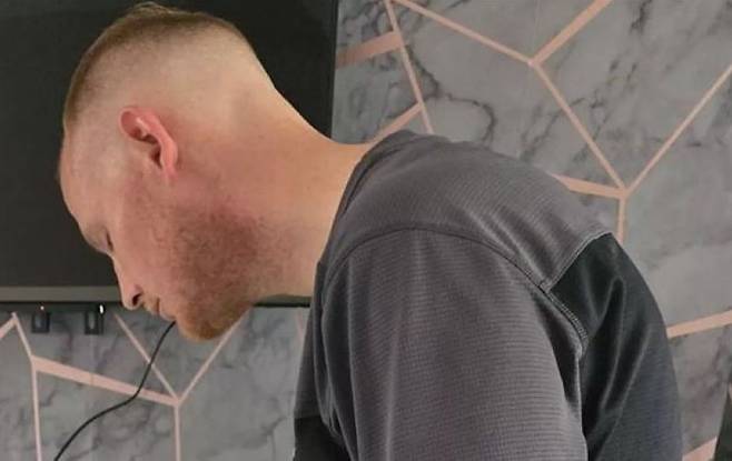 조나단 존슨(35)은 강직성척추염으로 목이 완전히 구부러졌다./사진=더 미러