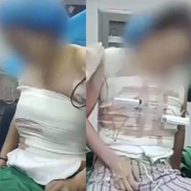 [서울=뉴시스] 16일 홍콩 사우스차이나모닝포스트(SCMP)에 따르면 지난 1월 가오라는 성을 가진 여성 A씨는 중국 중부 허난성의 한 성형외과 병원에서 가슴 확대 수술을 받았다. (사진=SCMP 보도 갈무리) *재판매 및 DB 금지