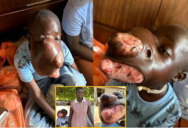 얼굴 형체를 알아볼 수 없을 만큼 뒤덮인 거대한 종양으로 인해 숨을 제대로 못 쉴 뿐 아니라, 보는 것도, 먹는 것도 힘들어 하는 9세 소년의 사연이 전해졌다. 하단 왼쪽 심바라쉬와 그의 엄마 마리아. 점점 종양이 커져 코와 입을 뚫고 나온 모습. [사진=영국일간 더선 보도 갈무리]
