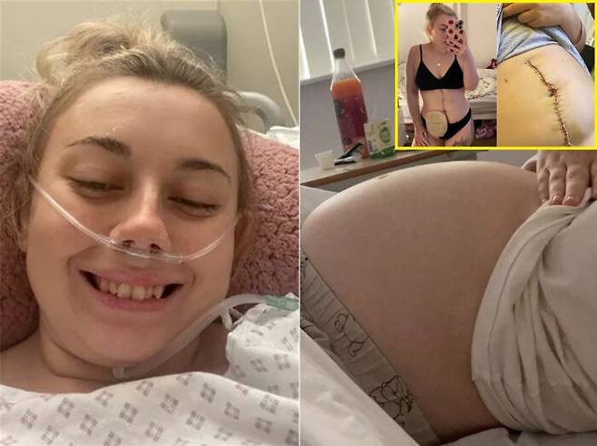 엠마 콜리지(25)는 23세에 난소암 3기 진단을 받았다. 배가 임신한 것처럼 부풀어 오르고 복부팽만감을 느낀 엠마는 자신의 왼쪽 난소에 30cm 크기의 종양이 있다는 사실을 확인했다. 두 차례의 수술과 항암치료 후 완치 판정을 받았지만 엠마는 배변주머니인 장루(오른쪽 위)를 달아야만 했고 불임 위험이 높은 것으로 전해졌다. [사진=영국 매체 미러 보도 갈무리 / SWNS 'Emma Colledge']