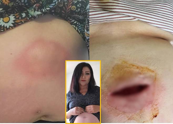 지방용해주사를 맞은 라니는 부작용으로 복부에 농양이 발생했고 거의 작은 양배추만한 크기로 커져갔다. 결국 농양은 터져서 라니의 배에 깊이 약 7cm, 폭 약 10cm 의 구멍을 남겼다.  [사진=미국 뉴욕포스트 보도 갈무리]