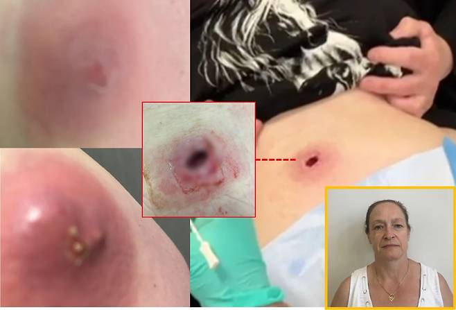 배에 난 작은 붉은 점을 여드름 정도로만 생각하고 며칠을 놔뒀다가 살을 도려내야 하는 상황에까지 이른 한 여성의 사연이 전해졌다. [사진=영국 일간 더선 보도 갈무리]