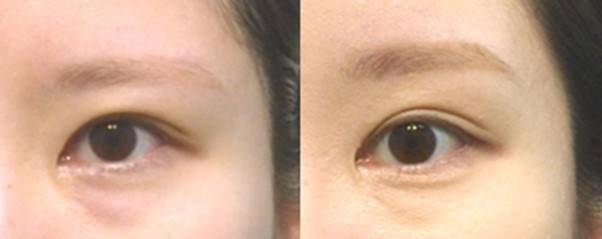 내시경 이마 눈썹 거상으로 눈썹을 들어 눈동자의 앞쪽이 잘 보이도록 올려줌.