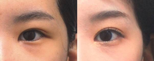 쌍꺼풀 수술과 함께 '위트임'을 시행해 눈앞머리쪽이 떨어지는 느낌이 완화됨.