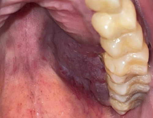 HIV 감염으로 왼쪽 잇몸과 입천장에 걸쳐 3cm 길이의 두껍고 부드러운 보라색 덩어리인 카포시육종이 생긴 모습./사진=임상사례보고저널