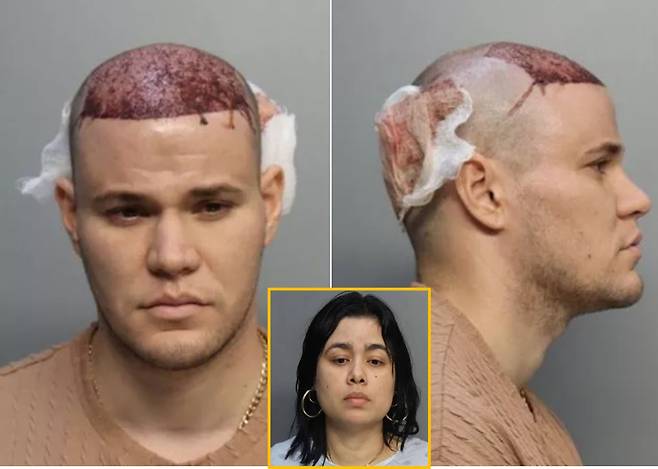 미국에서 한 남성이 모발 이식 수술을 받은 후 비행기를 탔다가, 쫓겨나는 사건이 발생했다. 그의 두피에서 피가 흐르는 상황이 발생해 항공사 직원들이 혈액 오염 위험을 이유로 들며 그의 탑승을 거부한 것이다. 비행기에서 내리지 않겠다고 버티다 경찰에 강제 연행돼 찍은 해당 남성의 머그샷 모습/ 아래는 그의 여자친구 [사진= 데일리익스프레스us]