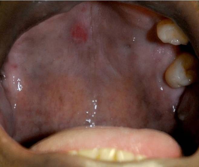 매독 감염에 의해 입 천장에 통증 없는 궤양이 발생한 모습./사진=임상사례보고저널