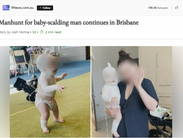 화상을 입은 아이. 9뉴스 보도 캡처