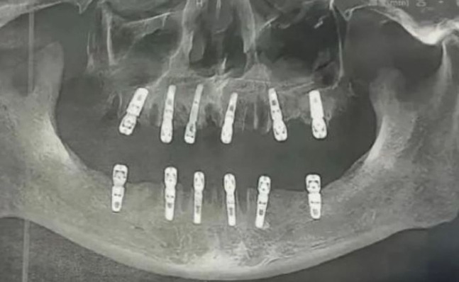 중국에서 하루에 23개의 치아를 뽑고 임플란트 12개를 이식한 남성이 13일 후 심장마비로 사망했다. [상하이데일리]