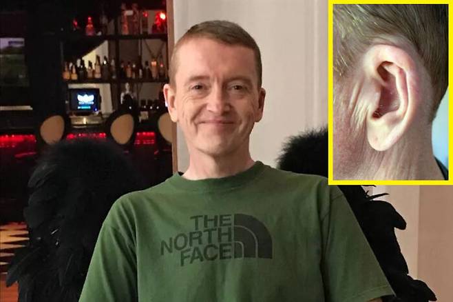 귀 뒤에 생긴 점이 악성피부암이라는 진단을 받은 영국의 50대 남성 사연이 공개됐다. 남성은 종양 제거를 위해 귀 일부를 절제하는 수술을 받았다. [사진=영국 매체 미러 보도 갈무리]