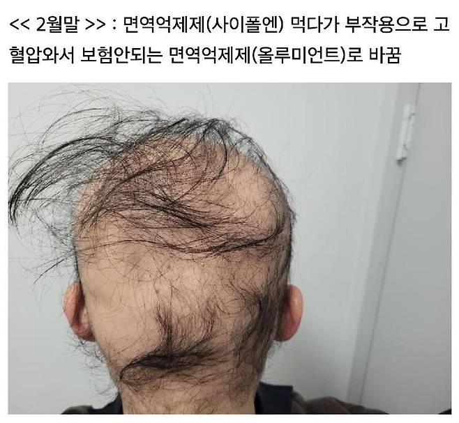 급성탈모 레전드 ㄷㄷㄷㄷㄷㄷㄷㄷㄷ.jpg