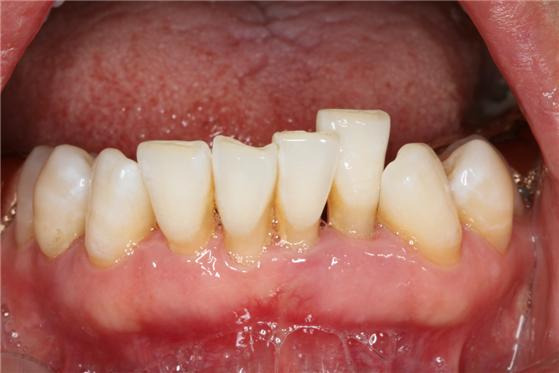 치주질환과 정출로 인해 잇몸이 퇴축되고 치아 뿌리가 상당 부분 드러난 모습. /사진=관악서울대치과병원