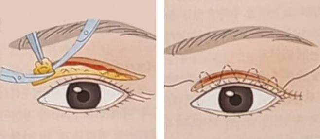윗눈꺼풀의 얇은 피부를 잘라내고 봉합하는 전통적 '상안검 성형술'[사진=강진성 성형외과학(2004)]