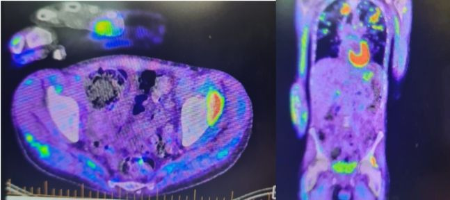 폐에 감염된 균이 팔꿈치로 퍼져 패혈성 관절염까지 일으켰다. 이후 균이 허리뼈와 왼쪽 엉덩이로까지 퍼졌다. 사진=뉴스닷컴호주