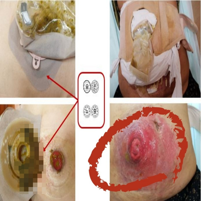 인공항문과 장루주머니 모습. 표시된 부분에 피부 손상이 발생했다. [병원상처장루실금간호사회 제공]