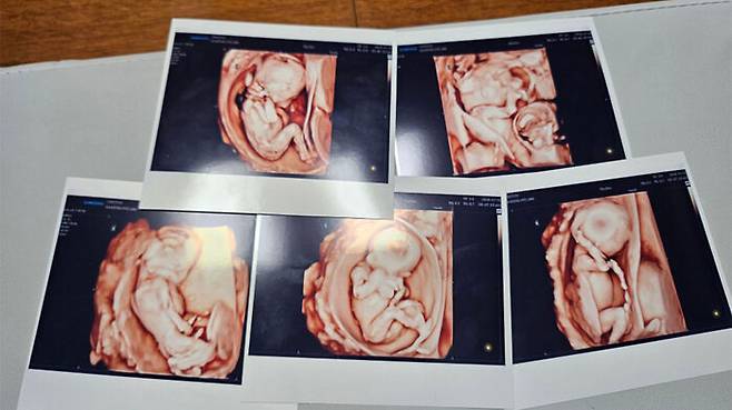 서울성모병원은 20일 낮 남자아이 3명과 여자아이 2명의 '오둥이'가 건강하게 태어났다고 밝혔다. 사진은 오둥이의 초음파 사진.