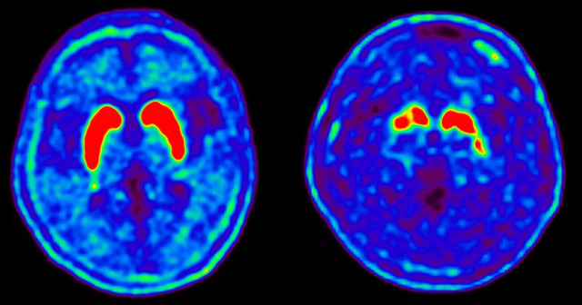 정상(왼쪽)과 파킨슨병 환자의 도파민 운반체 양전자단층촬영(PET) 검사 사진. 파킨슨병 환자의 PET 검사 사진에서 ‘도파민을 생성하는 신경세포’(붉은 색)가 퇴행된 것을 확인할 수 있다. 사진 제공=서울아산병원