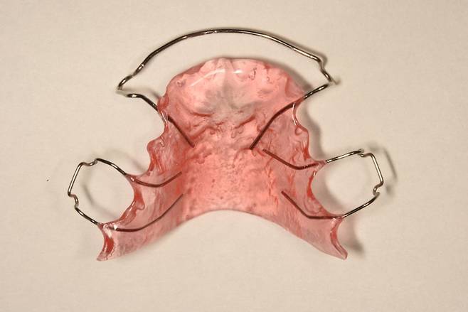 가철식 유지장치 모습. /사진=서울대치과병원