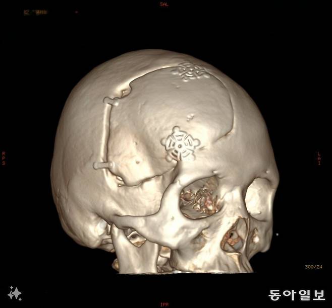 강경아씨의 3차원 뇌 사진. 광범위하게 뇌를 절제한 흔적이 보인다. 중앙대병원 제공