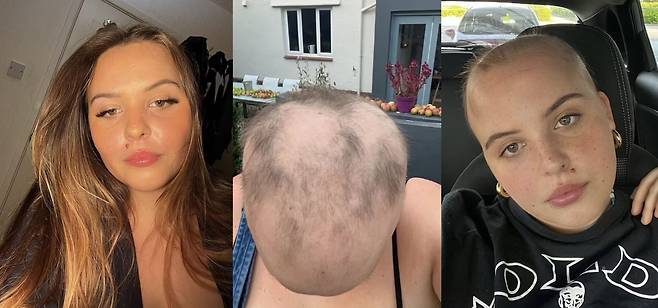 탈모 이후 외모 자신감을 잃은 몰리는 남아있는 머리카락을 기부하기 위해 삭발을 한 후 오히려 자신의 모습을 사랑하게 됐다. 왼쪽부터 몰리가 머리카락 빠지기 전 풍성했던 모습에서 머리카락이 계속 빠져 대머리가 되기까지의 모습 [사진=영국 일간 데일리메일]