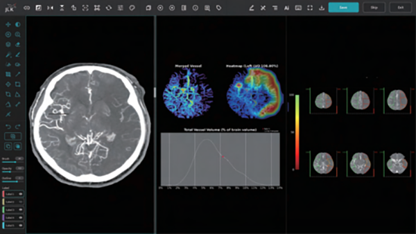 최근 미국 FDA로부터 승인을 획득한 제이엘케이 뇌졸중 진단 AI솔루션 'JLK-LVO' 분석 영상 사진. 실제 영상엔 병변 부위, 부피, 중증도, 원인, 관류 등 세부 데이터가 표시돼 의사의 효율적 최종 진단을 돕게 된다.
