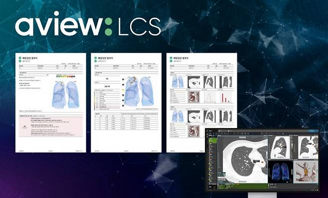 폐암 검진 AI 솔루션을 사용한 환자용&nbsp;검사 결과지 예시. 코어라인 제공