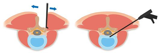 기존 척추 수술(왼쪽)과 내시경 척추 수술(오른쪽) 방식 비교. /그림제공=강동경희대병원