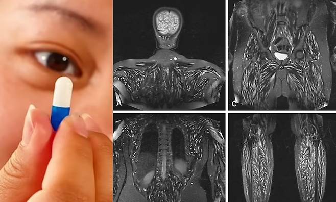 건강상 문제를 일으킨 것은 돼지 촌충이었다. 이 기생충은 알을 몸속으로 방출해 혈류를 통해 근육과 뇌에 퍼져 낭포충증을 일으킨다. 이 알들은 주로 무해하지만 뇌와 같은 민감한 조직에 발생하면 문제가 된다. [사진= 영국 데일리메일 보도 갈무리 /출처= 유튜브 Chubbyemu]