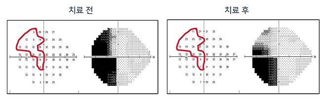 비비드브레인 치료 전과 치료 후 시야를 비교한 사진. 보이지 않는 검은 부분이 크게 줄었다./강동화 대표 제공