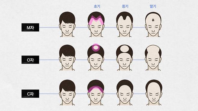 유형·시기 별 탈모 양상. 그래픽 최수아.