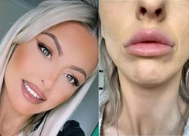 캐서린 투물카의 보톡스 시술 전후 사진. [사진='더 미러' 보도사진 갈무리]