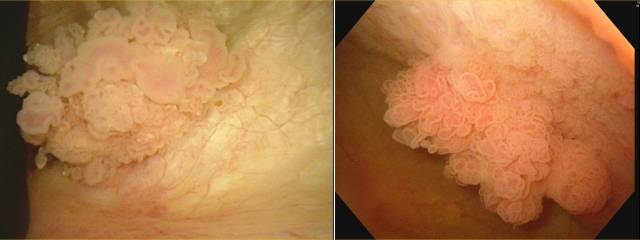 저등급(왼쪽)과 고등급 방광암 내시경 사진. 사진 제공=서울아산병원