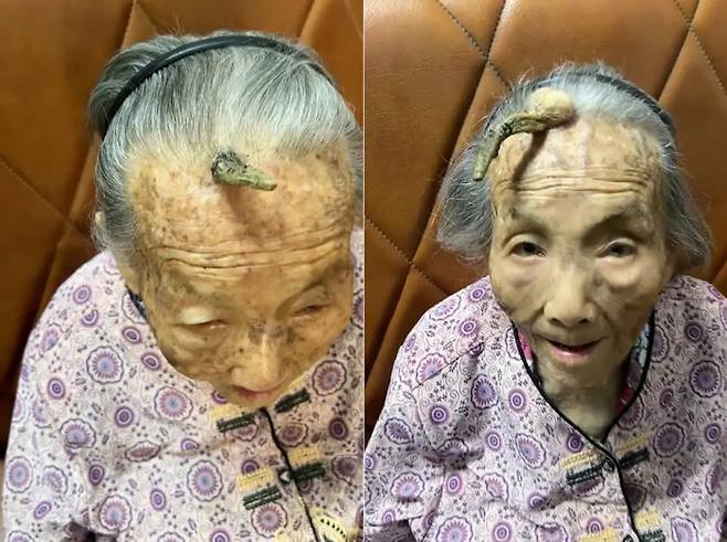 이마에 10cm 뿔을 지닌 107세 여성이 화제를 모으고 있다. [사진=뉴욕포스트 보도 갈무리]