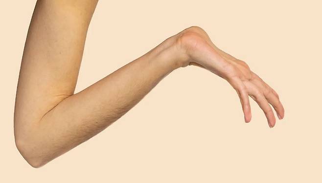 마르판 증후군 때문에 손이 과하게 유연한 모습/사진=Healthline