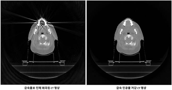 금속인공물에 의한 왜곡이 저감된 CT 영상(오른쪽).국가수리과학연구소 제공