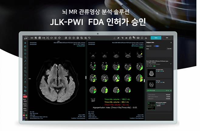 제이엘케이의 뇌 MR 관류영상 분석 인공지능 솔루션인 'JLK-PWI'가 미국 식품의약국(FDA)의 허가를 받았다. 사진은 해당 솔루션의 구동 장면./사진=제이엘케이