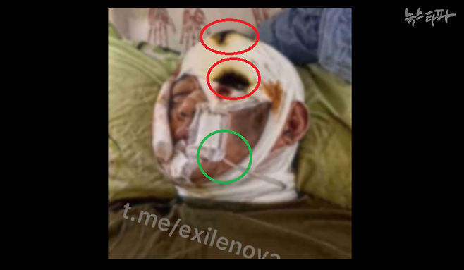 빨간 동그라미 : 불에 그을린 듯한 붕대/ 초록 동그라미 : 링거 호스