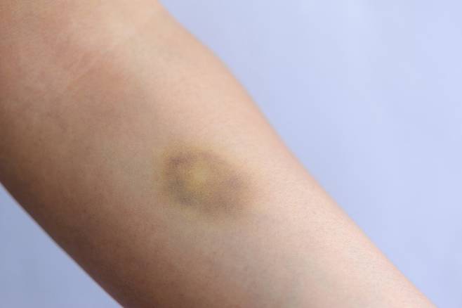 간이 손상되거나 기능에 문제가 생기면 출혈과 멍이 들기 쉬운데, 이는 흔한 부작용이다. [사진= 게티이미지뱅크]