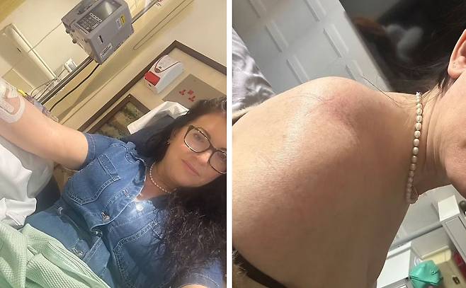 영국에 거주하는 클레어 터너(43)는 오른쪽 어깨에 점도 없이 당기고 붓는 증상이 나타났을 뿐인데, 진단 결과 피부암 말기였다./사진=데일리메일