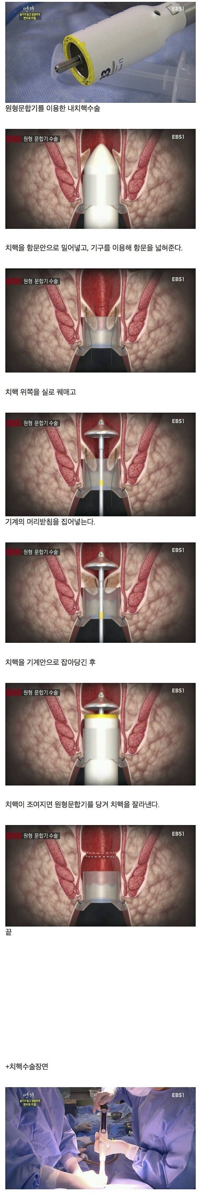 현실판감각차단함정.jpg 치질 걸린 사람들이 필독해야 하는 자료