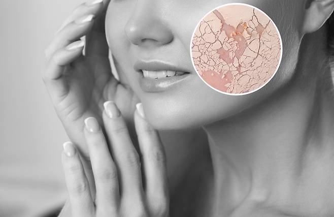 악건성 피부는 환절기에 각질층의 수분 함량이 줄어들면서 하얗게 들뜨거나 거칠어진다./사진=게티이미지뱅크