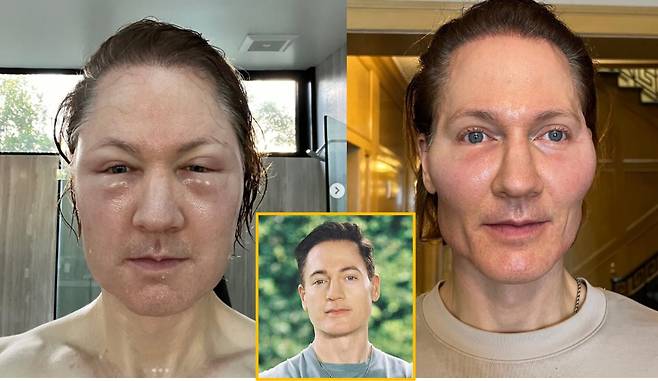 47세 바이오해커 브라이언 존슨이 '나이를 거스르는 회춘 치료'로 인한 알레르기 반응을 겪고 그 충격적인 사진을 공개했다. 왼쪽= 주사 30분후 부어오른 모습, 오른쪽은 부기가 가라앉은 후 광대쪽에 볼륨을 채운 모습[사진=브라이언 존슨 인스타그램 캡처]