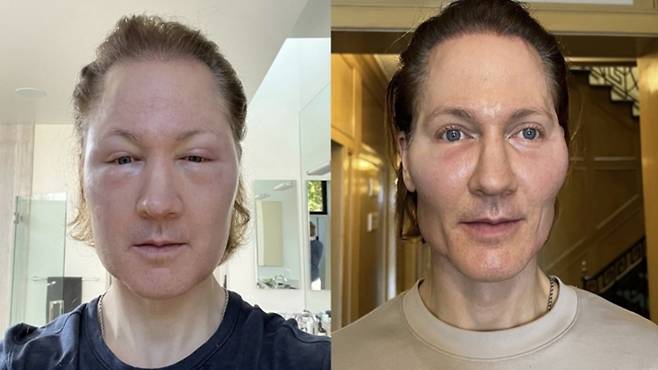 동안을 위해 지방 이식을 하기 전(오른쪽)과 후 / 브라이언 존슨 인스타그램 캡처