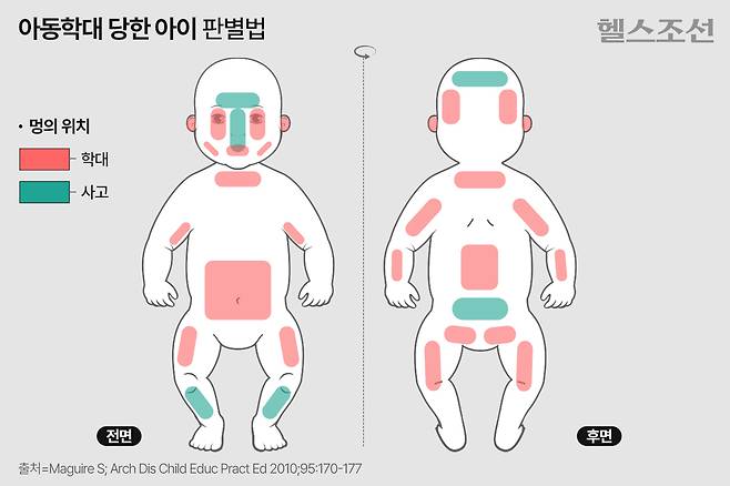 영국 카디프대 매과이어 교수가 발표한 아동학대 멍 패턴./그래픽=김민선