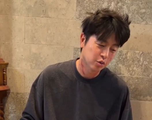 개그맨 유상무가 베트남 여행 중 나타난 햇빛 알레르기 증상에 고통을 겪었다고 전했다. 유상무 인스타그램