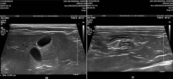 부산 24시온동물의료센터 고양이 담관간염 치료 사례, 치료 후 복부 초음파 사진 (동물병원 제공) ⓒ 뉴스1